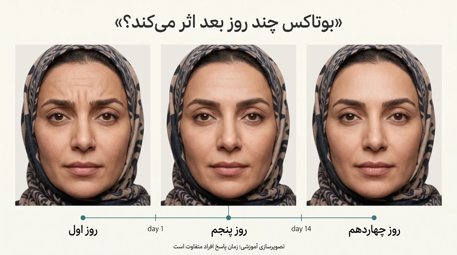بوتاکس چند روز بعد اثر میکند؟