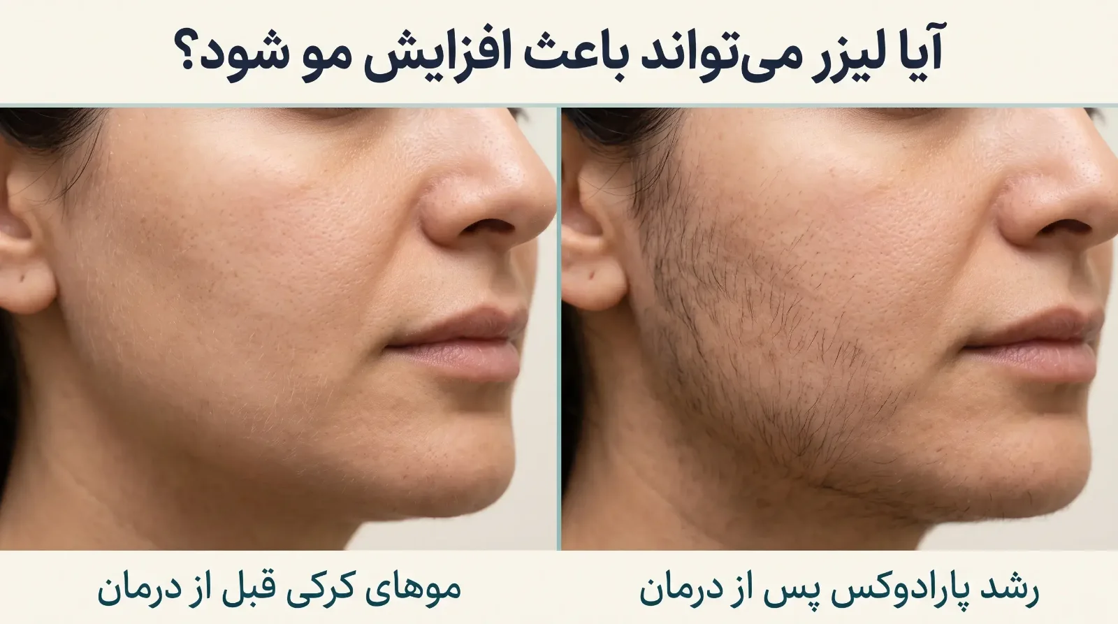 لیزر موهای زائد چند جلسه است
